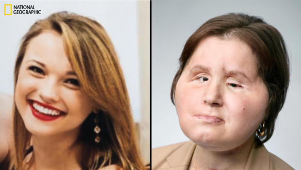 Woman Becomes Youngest Person Ever to Receive Face Transplant
